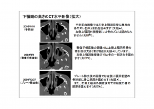 CT画像比較(位置合わせ画像)9-10