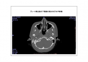 CT画像比較(位置合わせ画像)7-8