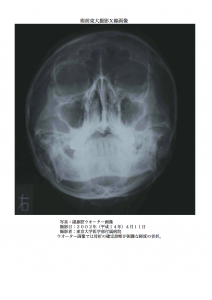 術前：副鼻腔ウオーター画像