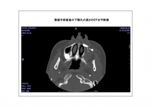 CT画像比較3-4