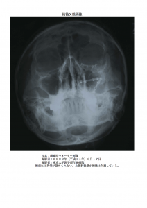 術後：副鼻腔ウオーター画像