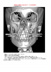 術後３DCT正面