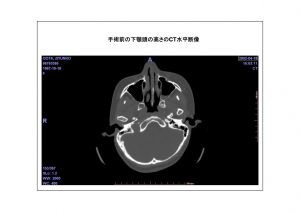 CT画像比較(位置合わせ画像)5-6