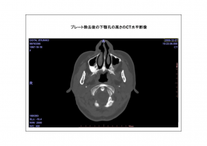 CT画像比較(位置合わせ画像)4-5