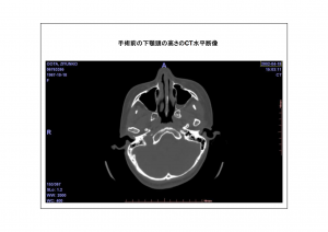 CT画像比較5-6