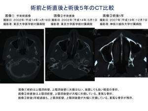 術前と術直後、術後５年の2次元ＣＴ比較1