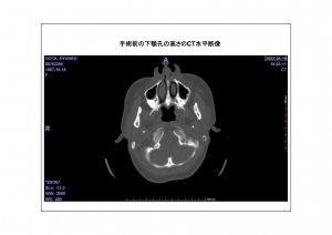 CT画像比較2-3