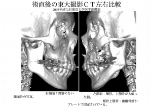 術後顔面骨左右比較1