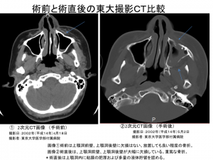 術前と術後の東大撮影2次元ＣＴ比較1