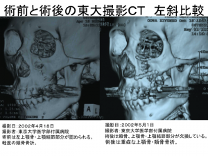 術前と術後の東大撮影ＣＴ比較(撮影位置：顔面左斜め）1