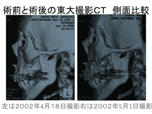 術前と術後の左顔面骨比較1