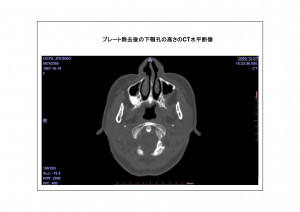 CT画像比較4-5